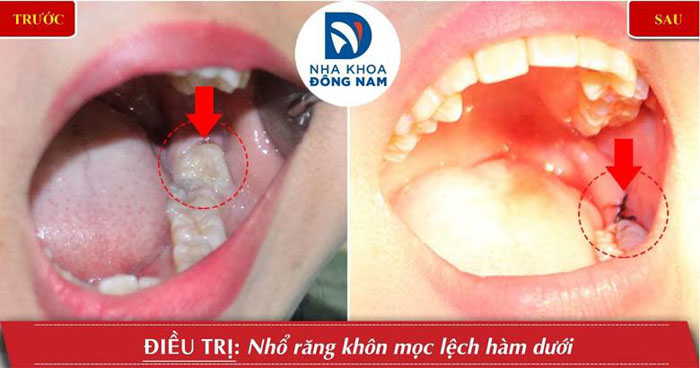 Răng khôn mọc lệch được khuyến cáo nhổ bỏ sớm nhất có thể