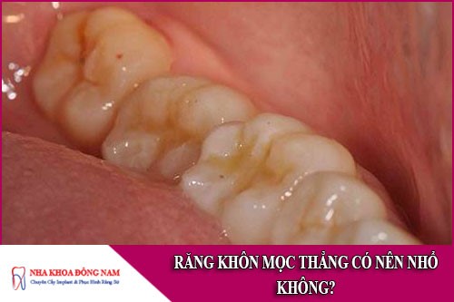 răng khôn mọc thẳng có nên nhổ không