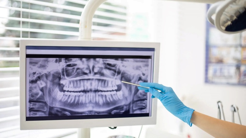 Răng khôn mọc thẳng không cần nhổ bỏ