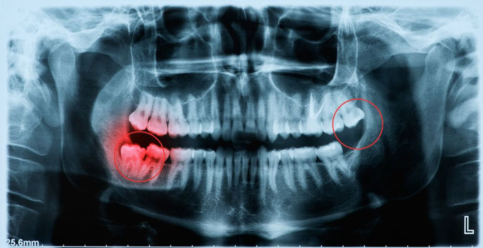 Răng khôn mọc thẳng nhưng kích thước lớn hoặc không có răng đối diện đều cần nhổ bỏ