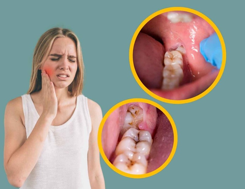 Răng khôn nếu mọc lệch gây cản trở trong ăn nhai, chăm sóc răng miệng