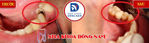 răng nhai bị đau e buốt