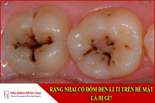 Răng nhai có đốm đen li ti trên bề mặt là bị gì