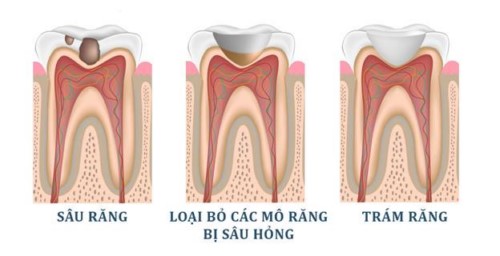 quy trình trám răng nhai