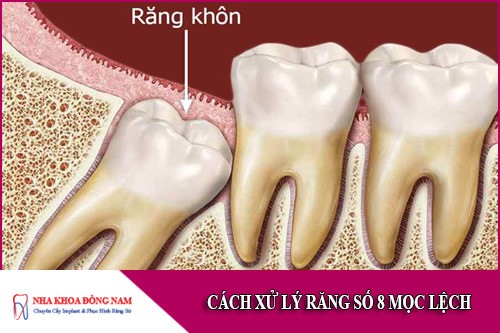 cách xử lý răng số 8 mọc lệch