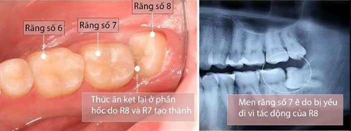 Răng số 8 mọc lệch gây nhiều tổn hại cho răng số 7 bên cạnh