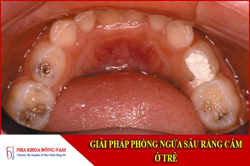 giải pháp phòng ngừa sâu răng cấm ở trẻ