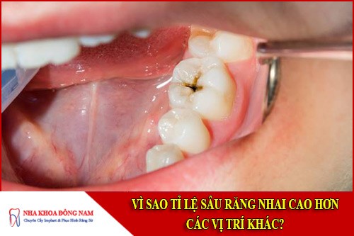 Vì sao tỉ lệ sâu răng nhai cao hơn các vị trí khác?