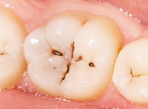 sâu răng mặt nhai