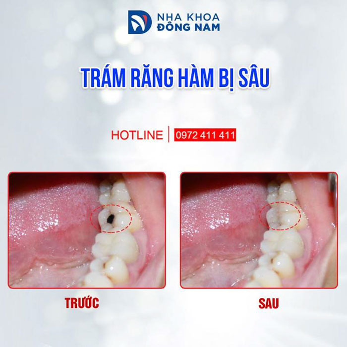 Trám răng cho trường hợp răng sâu nhỏ