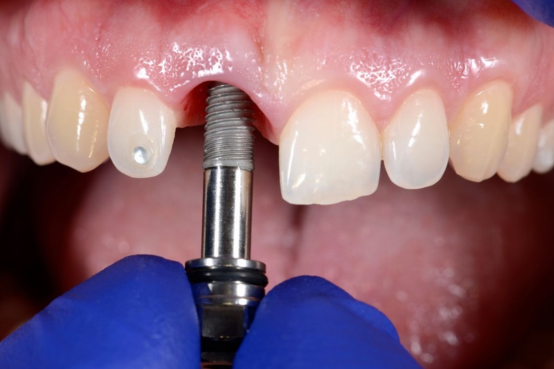 Trồng răng Implant là giải pháp tối ưu thay thế cầu răng sứ
