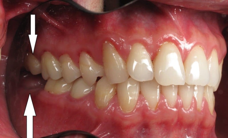Trường hợp răng khôn mọc thẳng nhưng không có răng đối diện cần nhổ bỏ
