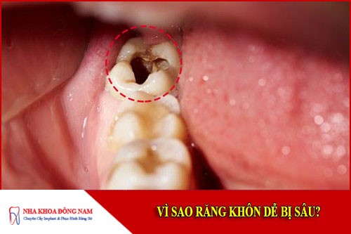 vì sao răng khôn dễ bị sâu