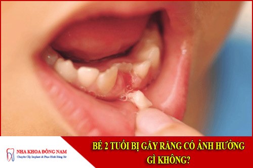 Bé 2 tuổi bị gãy răng có ảnh hưởng gì không?