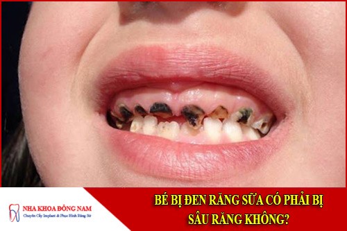 Bé bị đen răng sữa có phải bị sâu răng không?
