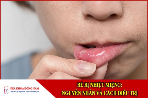 Bé bị nhiệt miệng: Nguyên nhân và cách điều trị