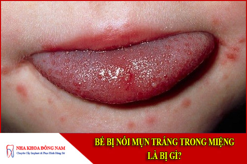 Bé bị nổi mụn trắng trong miệng là bị gì?