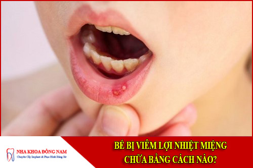 Bé bị viêm lợi nhiệt miệng chữa bằng cách nào?