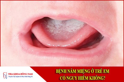 Bệnh nấm miệng ở trẻ em có nguy hiểm không?