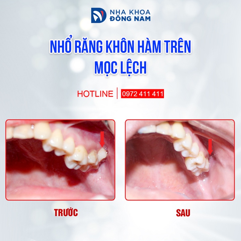 Bệnh nhân sau khi nhổ răng khôn hàm trên