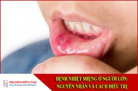 Bệnh nhiệt miệng ở người lớn: Nguyên nhân và cách điều trị