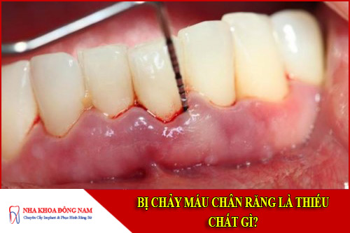 Bị chảy máu chân răng là thiếu chất gì?