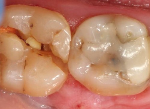 răng cấm bị mẻ vở