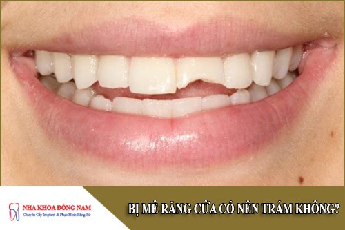 Bị MẺ RĂNG CỬA có nên trám không?
