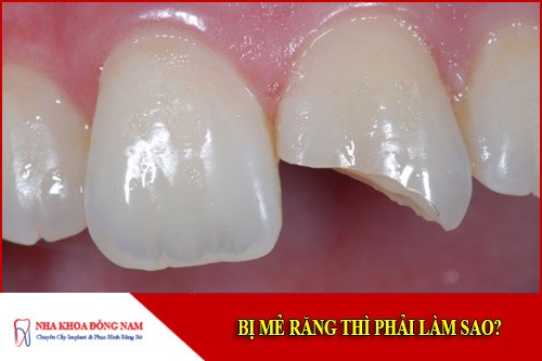Bị mẻ răng thì phải làm sao?