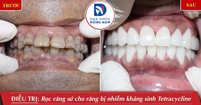 Bọc răng sứ cho răng bị nhiễm màu kháng sinh nặng