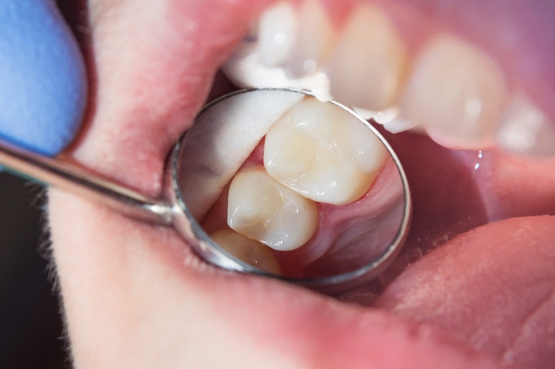 Bọc răng sứ giúp bảo tồn chân răng tốt hơn