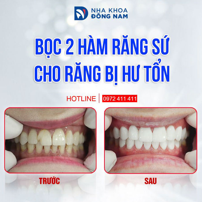 Bọc răng sứ khắc phục răng gãy mẻ đạt thẩm mỹ tối ưu