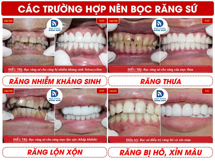 Bọc răng sứ không gây hôi miệng mà còn đem lại thẩm mỹ khá tốt