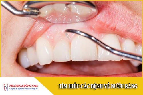 Tìm hiểu các bệnh về nướu răng