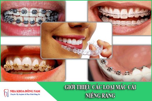 Bác sĩ giới thiệu các loại mắc cài niềng răng
