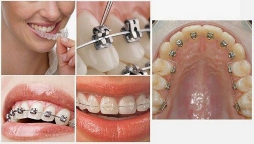 mắc cài niềng răng nào tốt