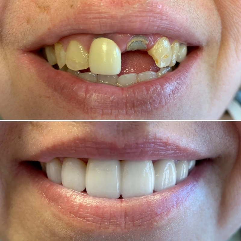 Cầu răng sứ phục hình răng gãy cố định