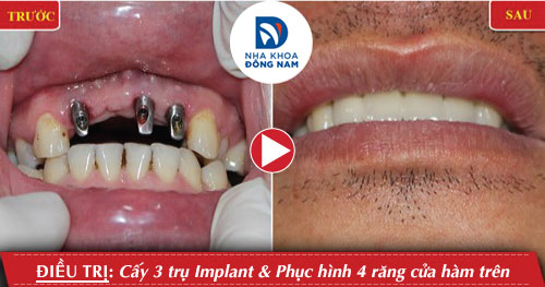 Cấy 3 trụ Implant răng của gắn 4 răng