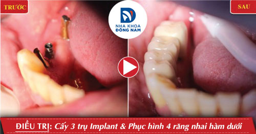 Cấy 3 trụ Implant gắn 4 răng nhai hàm dưới