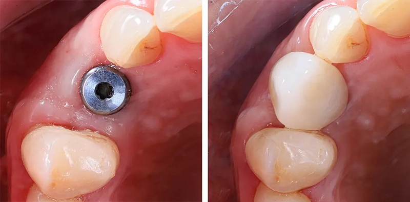 Cấy ghép Implant phục hình răng mất toàn diện