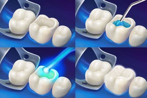 mô phỏng kỹ thuật trám răng