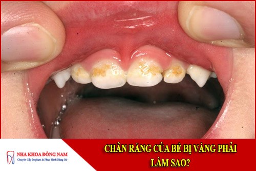 Chân răng của bé bị vàng phải làm sao?