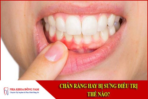 Chân răng hay bị sưng điều trị thế nào?