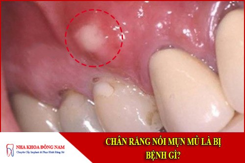 Chân răng nổi mụn mủ là bị bệnh gì?