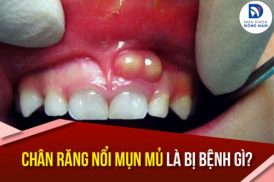Chân răng nổi mụn mủ là bị bệnh gì?