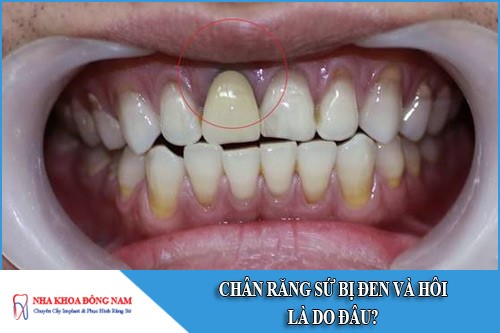 Chân răng sứ bị đen và hôi là do đâu?
