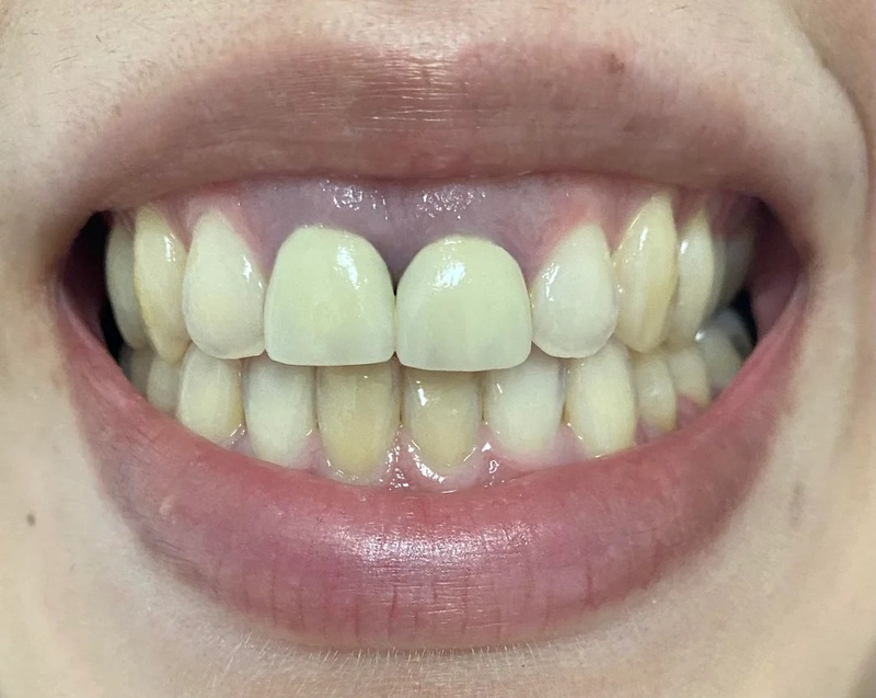 Chân răng sứ bị hôi và đen viền do dùng răng sứ kim loại