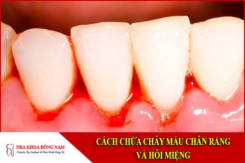 Cách chữa chảy máu chân răng và hôi miệng