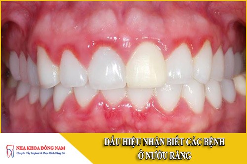 Dấu hiệu nhận biết các bệnh ở nướu răng