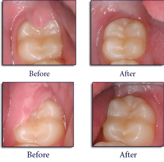 Điều trị cắt lợi trùm trong trường hợp răng khôn mọc thẳng có thể giữ lại